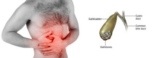Safra Kesesi Sancısı Belirtileri ve Tedavisi